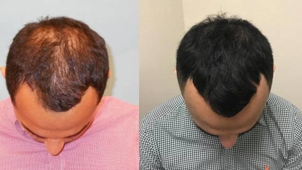 پی آر پی مو بهتر است یا مزوتراپی
