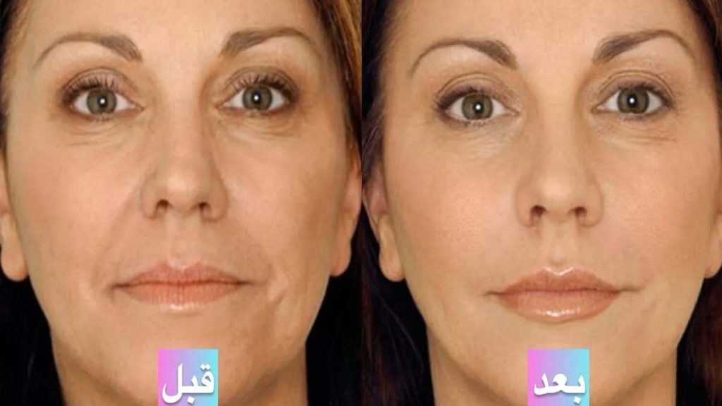 تعداد جلسات پی آر پی صورت
