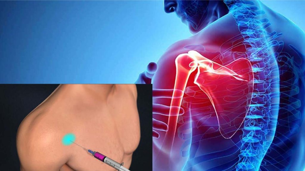 عوارض تزریق PRP شانه عوارض پی آر پی شانه