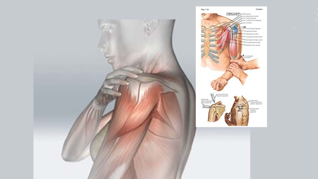 PRP برای شانه یخ زده