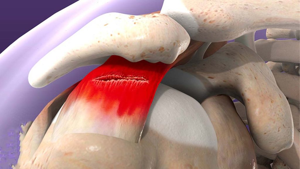 مزایای تزریق PRP شانه مزایای PRP شانه